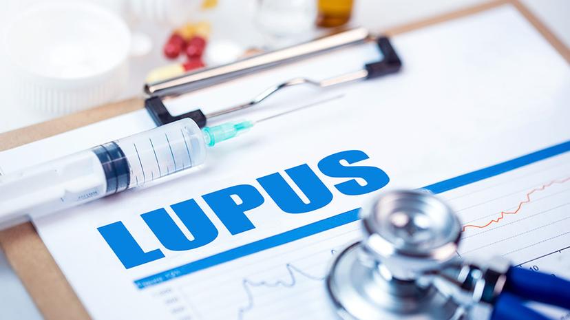 Lupus, muchos pacientes enfrentan diagnósticos tardíos
