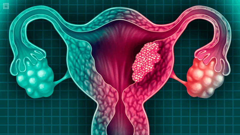 Más del 95% de los casos de cáncer cervicouterino se deben a la infección por el virus del papiloma humano