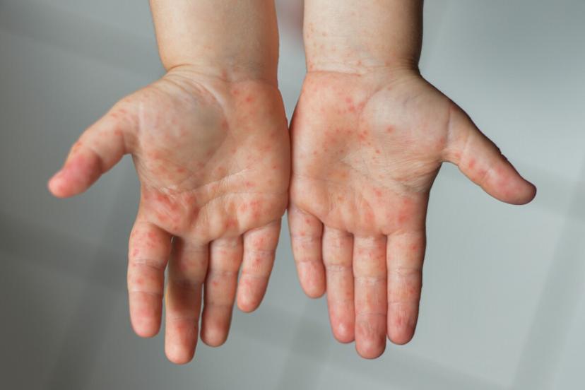 Confirman 14 casos de virus Coxsackie en niños de Texmelucan