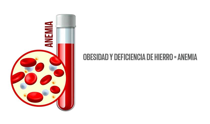 De esta manera están relacionadas la obesidad y deficiencia de hierro