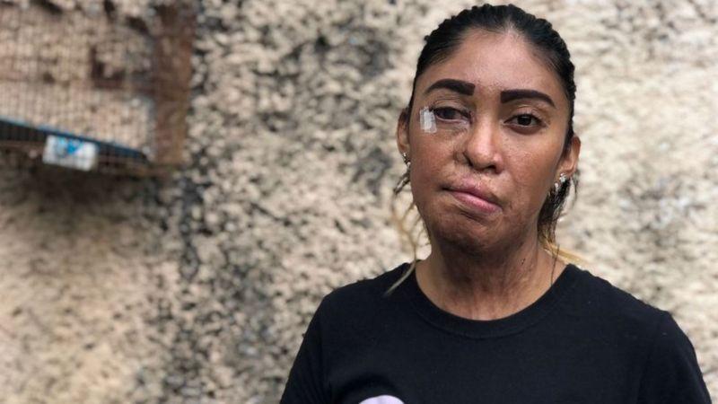 Así narra poblana a la BBC el ataque con ácido de su ex pareja