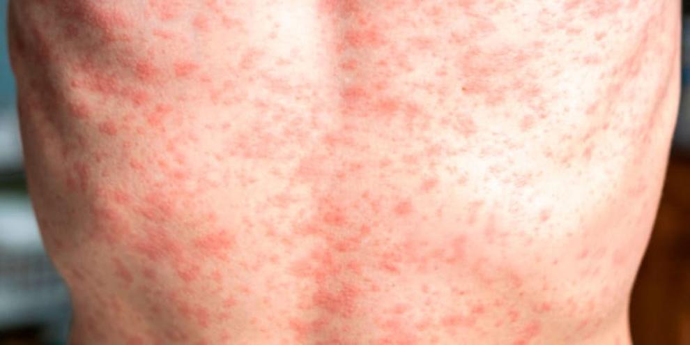 ¿Qué está pasando con el sarampión en el mundo?