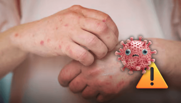 sarampion-alerta-sdp