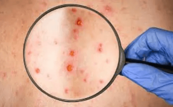 En el estado de Puebla 11 municipios presentan casos de sarampión.