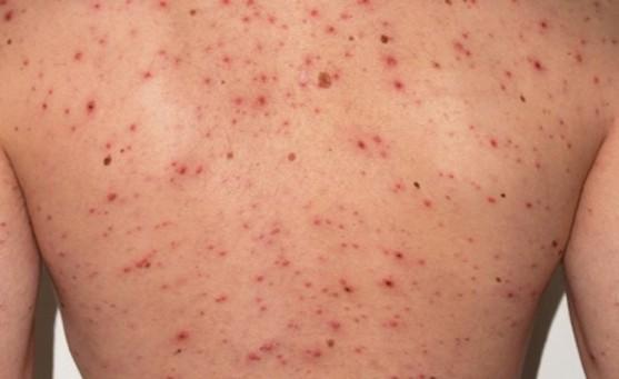 Puebla reporta 164 casos de sarampión en 15 municipios: SSa.