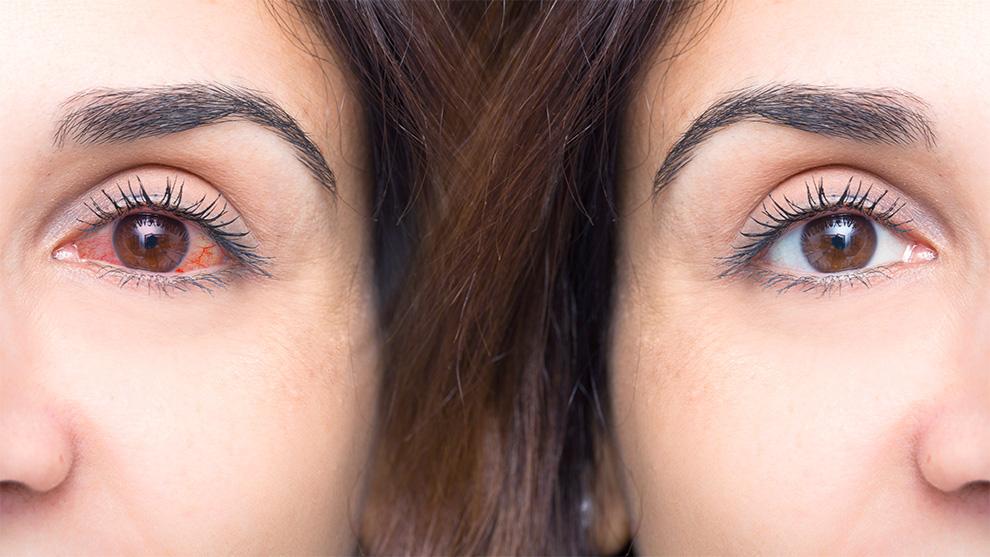 Se manifiesta con más frecuencia en mujeres que ya entraron en la menopausia.