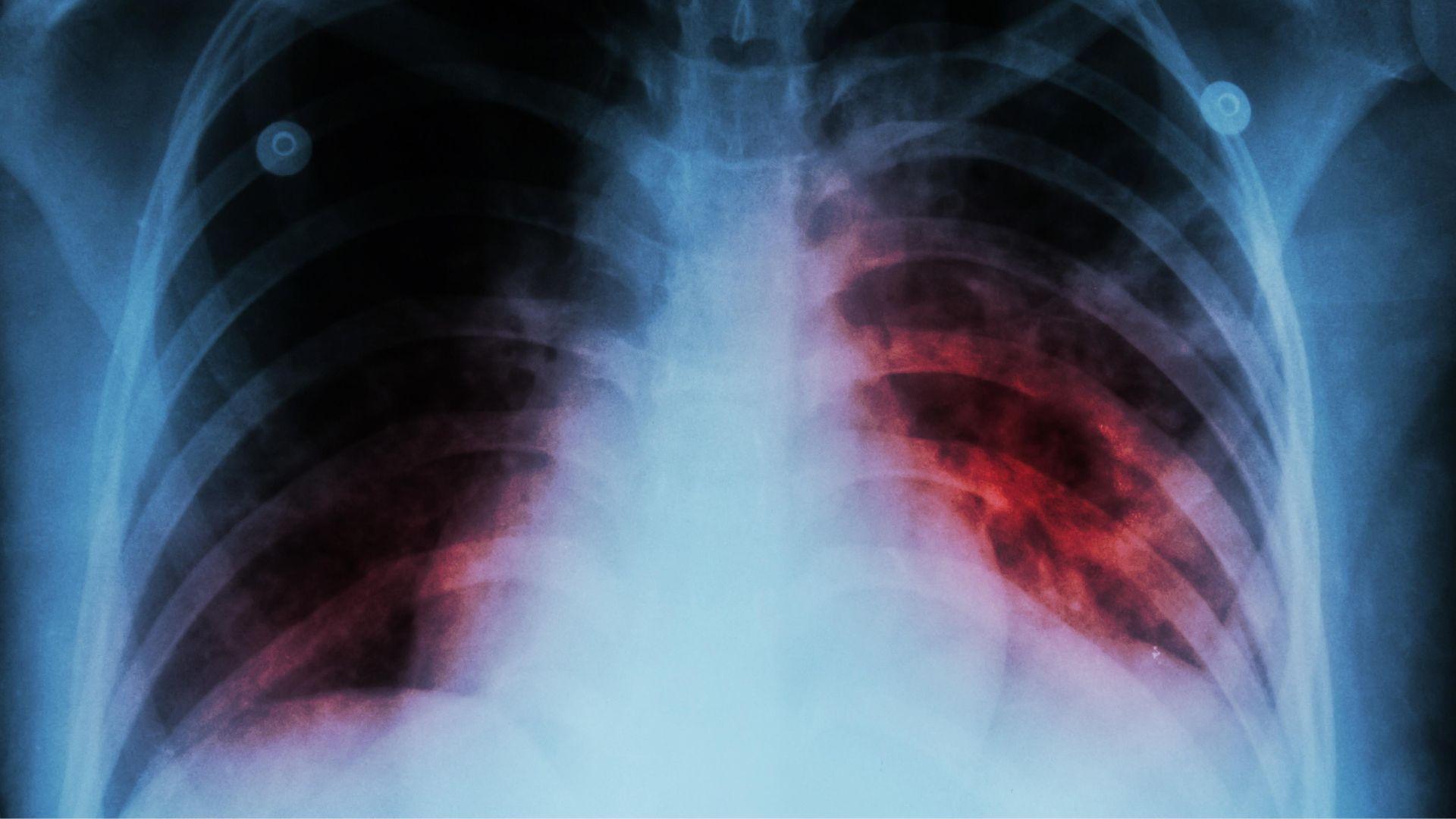 Ecosur alerta por la alarmante alza de casos de tuberculosis en todo México