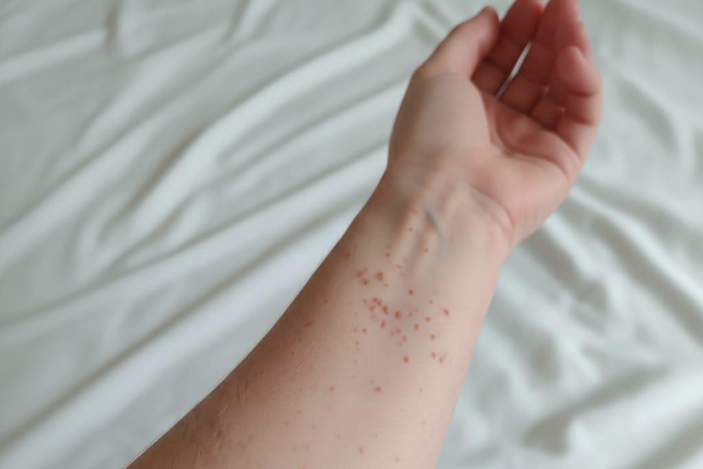 Brote de sarampión en Tlaxcala estaría afectando a poblanos.