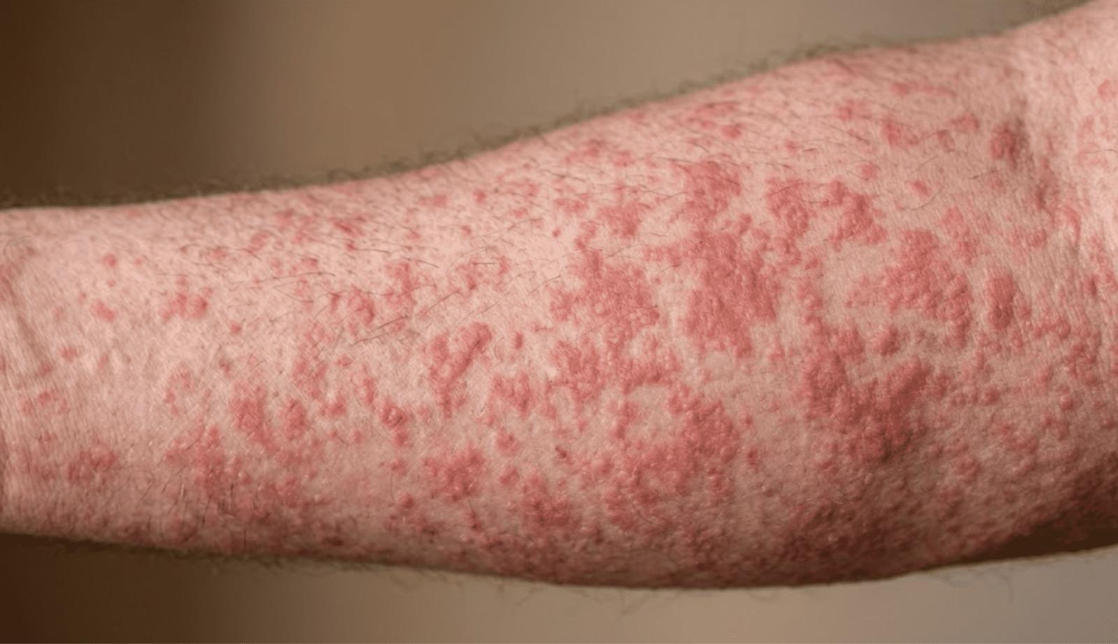 Puebla registra 186 casos de sarampión en 15 municipios.